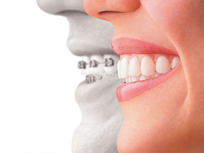Epident | Fluoride Treatment, Laser Dentistry and CEREC