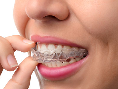 Epident | Inlays  amp  Onlays, Root Canals and Emergency Treatment