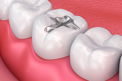 Epident | All-on-6 reg , Root Canals and Cosmetic Dentistry