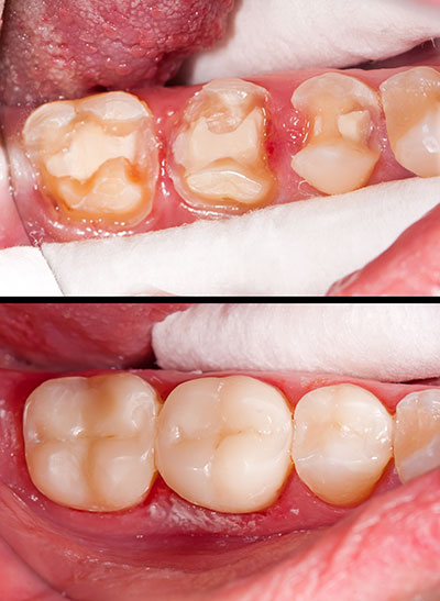 Epident | Dentures, Pediatric Dentistry and Snoring Appliances