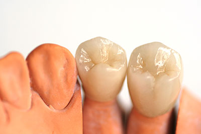 Epident | Dental Sealants, Extractions and EpiCleaning