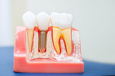 Epident | Fluoride Treatment, Night Guards and Veneers