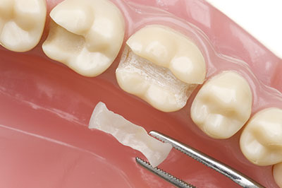 Epident | Full Mouth Reconstruction, ZOOM  Whitening and Preventative Program