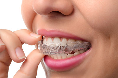 Epident | Inlays  amp  Onlays, Root Canals and ZOOM  Whitening