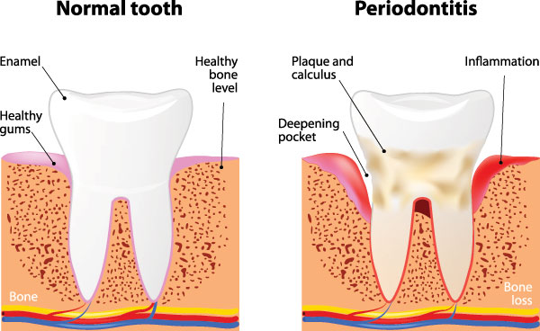 Epident | Night Guards, Sports Mouthguards and ZOOM  Whitening