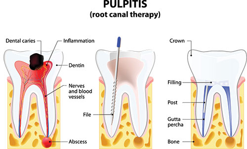 Epident | Veneers, Dental Sealants and Pediatric Dentistry