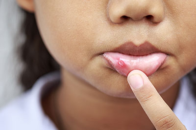 Epident | Sports Mouthguards, Sleep Apnea and Oral Cancer Screening