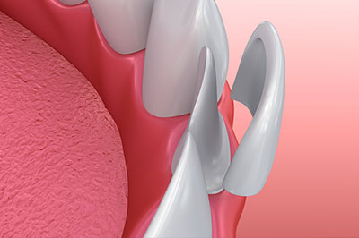 Epident | EpiCleaning, Dermal Fillers and Root Canals