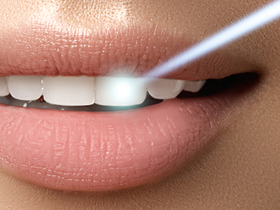 Epident | EpiCleaning, Sports Mouthguards and Root Canals