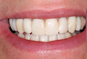 Epident | Dental Sealants, EpiExams and CEREC