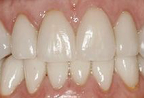 Epident | Inlays  amp  Onlays, CEREC and All-on-6 reg 