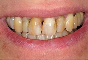 Epident | CEREC, Root Canals and Extractions