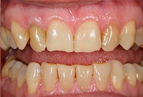 Epident | Teeth Whitening, Dental Bridges and Root Canals