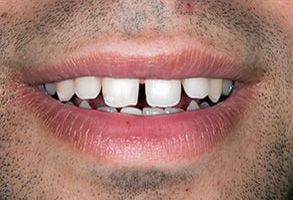 Epident | EpiCleaning, Cosmetic Dentistry and Sleep Apnea