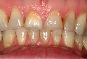 Epident | EpiExams, Ceramic Crowns and Invisalign reg 