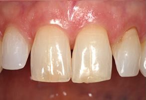 Epident | Dental Bridges, Dermal Fillers and Full Mouth Reconstruction